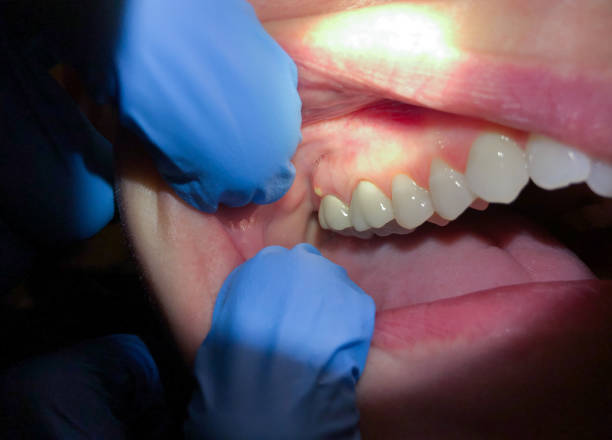 Best Teeth Whitening  in Wolcott, IN